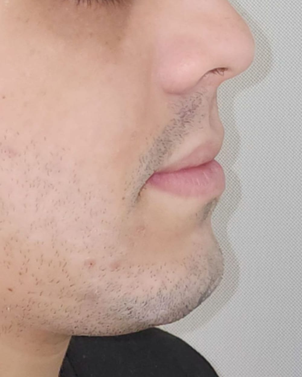 Perfil do mesmo paciente em maio de 2025, em repouso, sem o aparelho