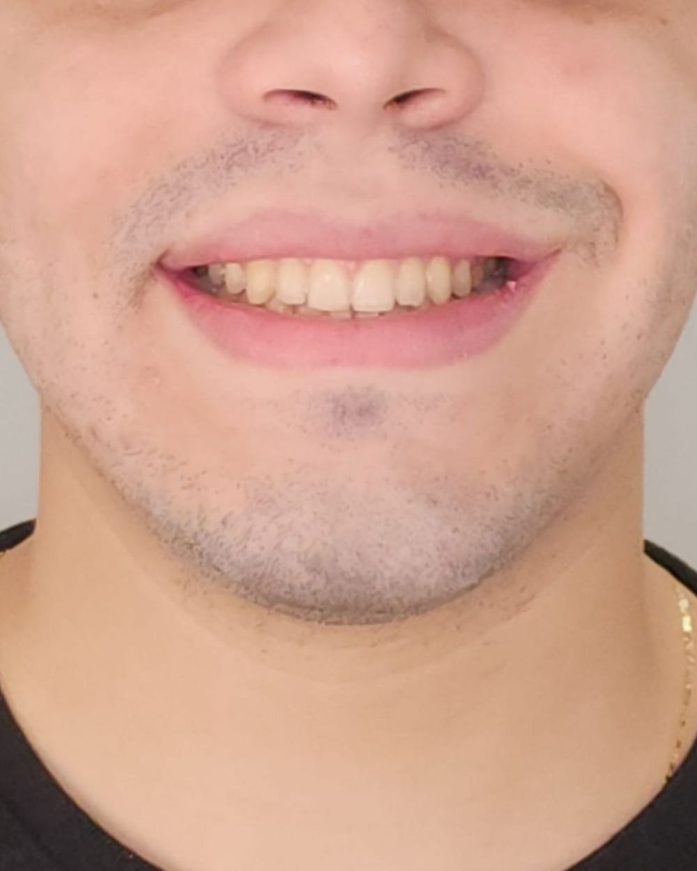 Sorriso do mesmo paciente em maio de 2025, sem o aparelho